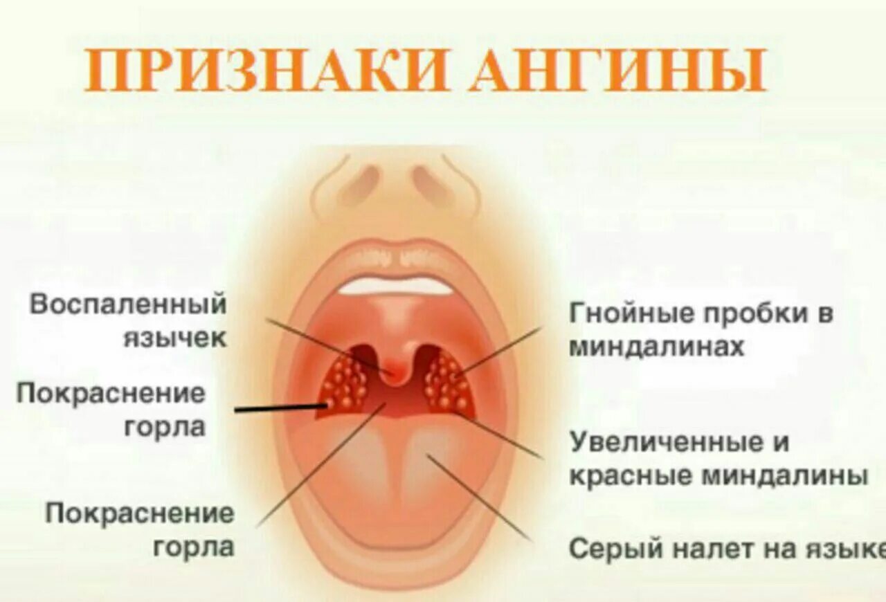 Полип на миндалине в горле фото Боль в гортани температура