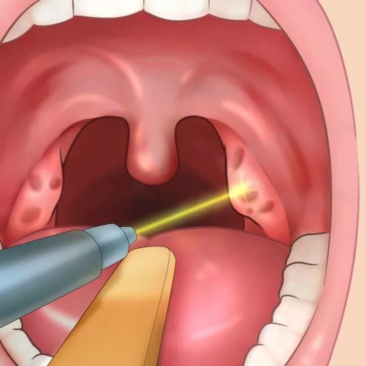 Полип на миндалине в горле фото Воспалилось небо - что делать?(Причины и лечение)