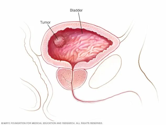 Полип уретры фото снаружи Bladder cancer - Symptoms and causes - Mayo Clinic