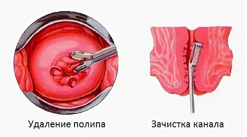 Полип уретры фото снаружи Полип шейки матки и его лечение - причины, симптомы, диагностика полипа цервикал