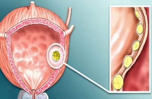 Полип уретры фото снаружи What causes polyps in the bladder in men