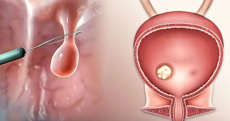 Полип уретры фото снаружи Картинки ПОЛИП СКОЛЬКО ДЛИТСЯ ОПЕРАЦИЯ
