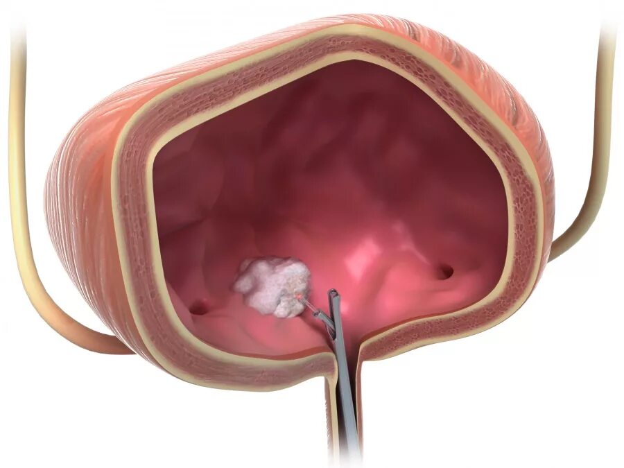 Полип уретры фото снаружи Illustration laser surgery bladder cancer - MedicalGraphics