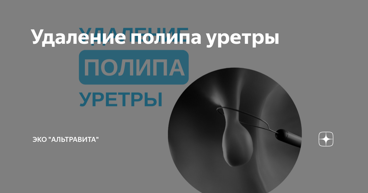 Полип уретры у женщин фото снаружи Удаление полипа уретры Клиника "АльтраВита" Дзен