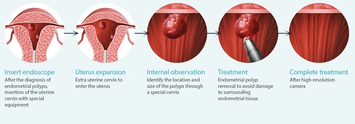 Полип уретры у женщин фото снаружи Endometrial (Uterine) Polyp: When to Remove vs. Wait, endometriosis heavy bleedi