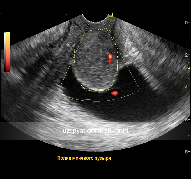 Полип уретры у женщин симптомы фото Большие проблемы малой нужды - УЗИ Пятигорск Шухнин Р. Е.