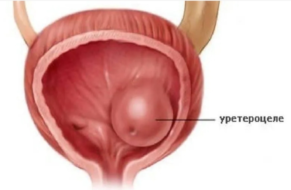 Полип уретры у женщин симптомы фото Лечение уретероцеле в Хабаровске - Медикъ