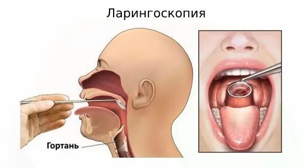 Полип в горле фото симптомы Хронический ларингит: причины, симптомы и лечение в статье ЛОРа Зайцев В. М.