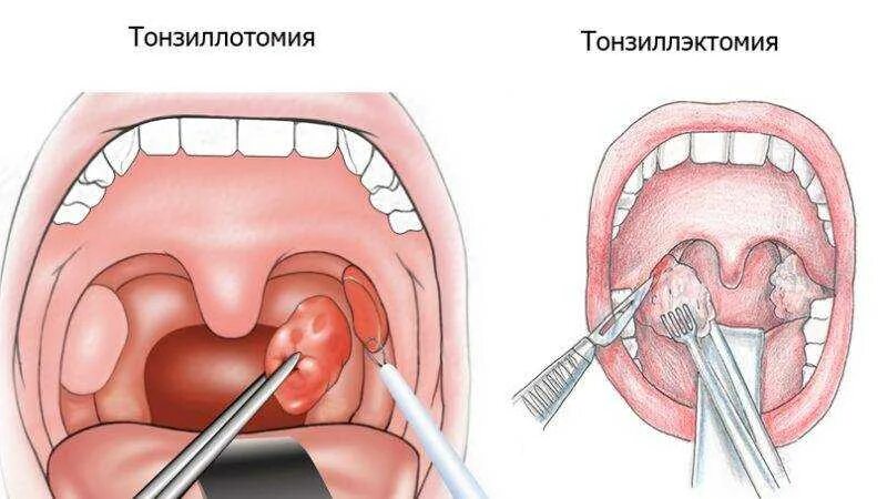 Полип в горле фото симптомы Удаление пробок из миндалин