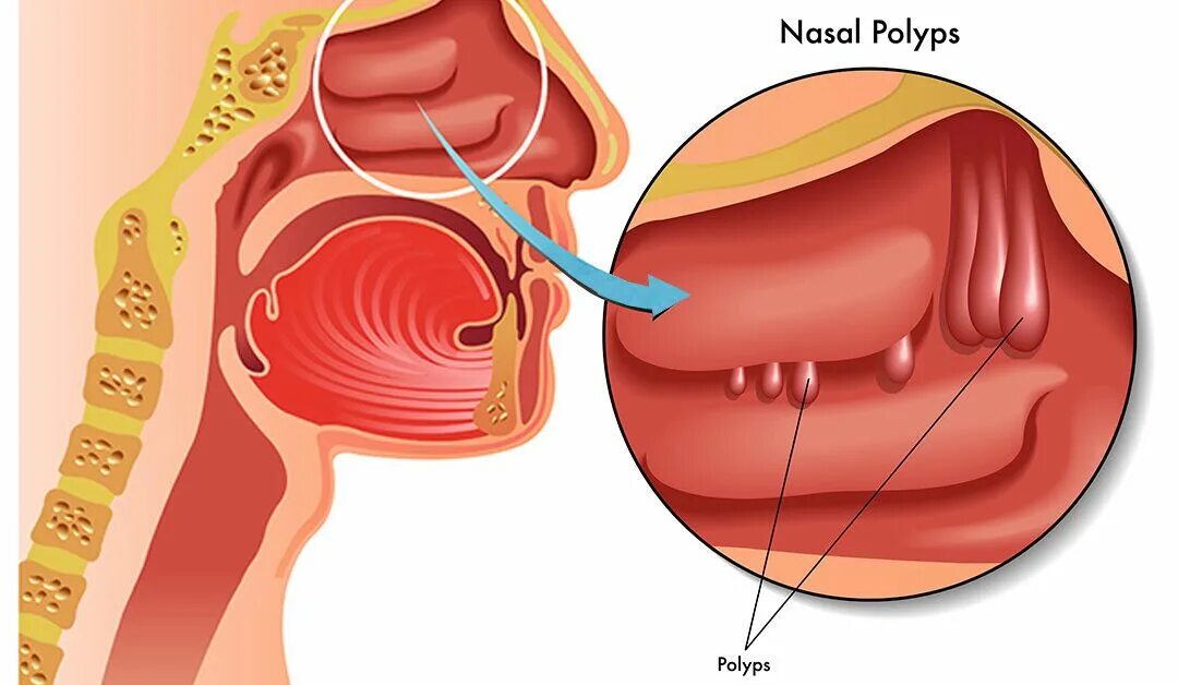 Полип в ухе фото Nasal Polyps - Shenoys ENT Clinic Laser surgery, Health, Body