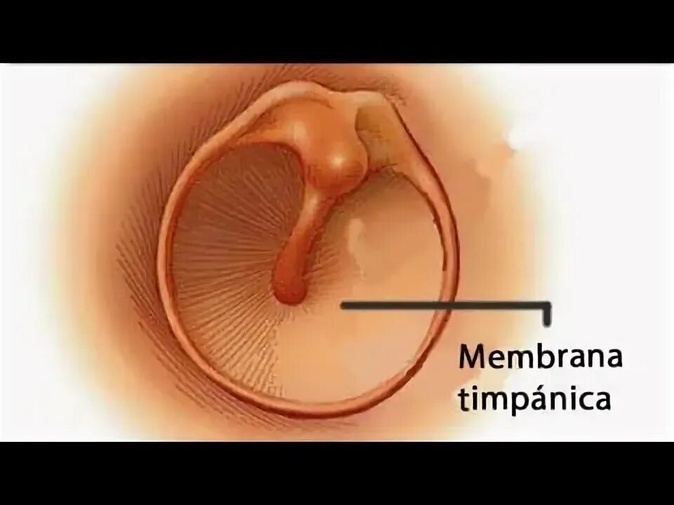 Полип в ухе фото Por qué puede estar causada una perforación timpánica? - YouTube