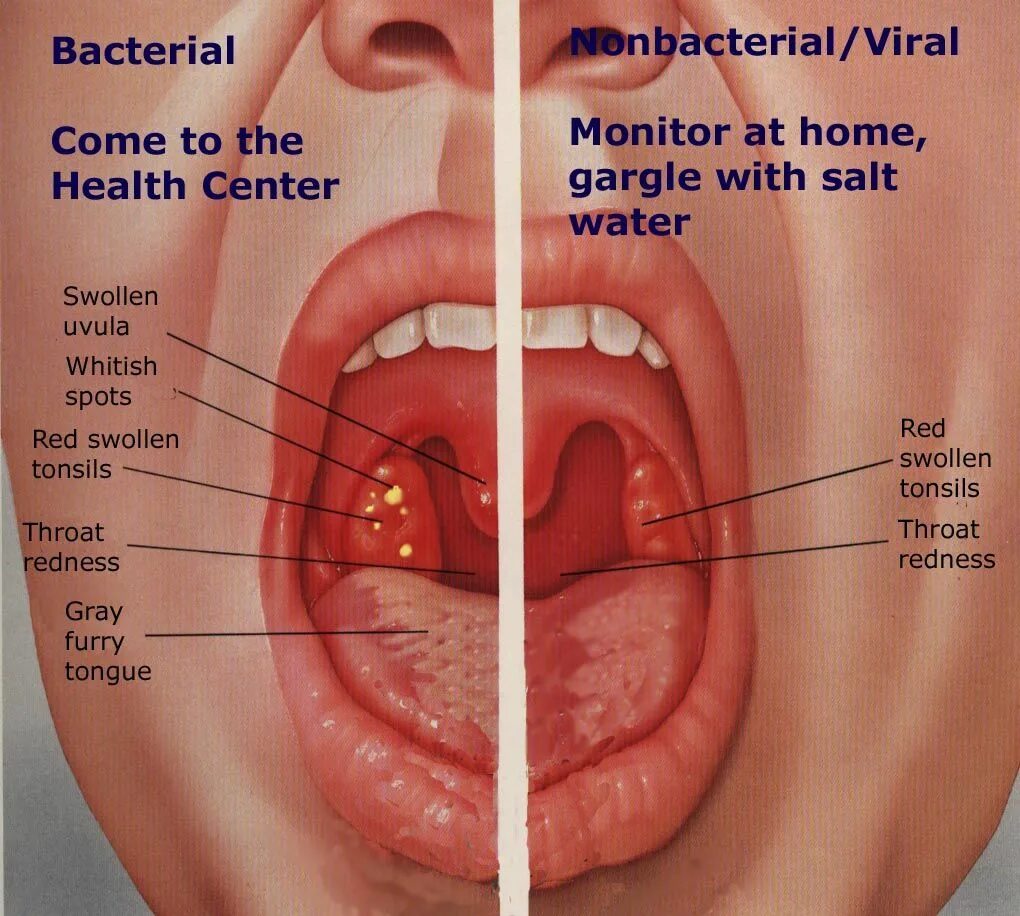 Полипы в горле фото у ребенка What do you think? Treatment for sore throat, Nursing tips, Health