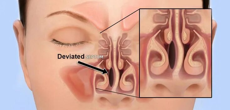 Полипы в носу симптомы у взрослых фото Septum Deviasyonu Nedir?