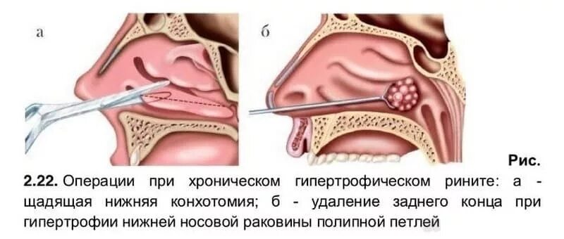 Полипы в носу симптомы у взрослых фото Ринит хронический: что это за заболевание, насморк носа причины и лечение у взро