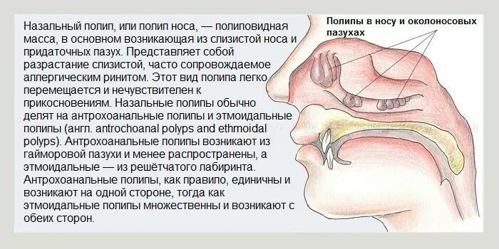 Полипы в носу симптомы у взрослых фото Лечение полипов эффективными народными средствами