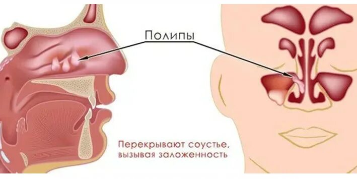 Полипы в носу симптомы у взрослых фото Новости Владивостокской клинической больницы № 1