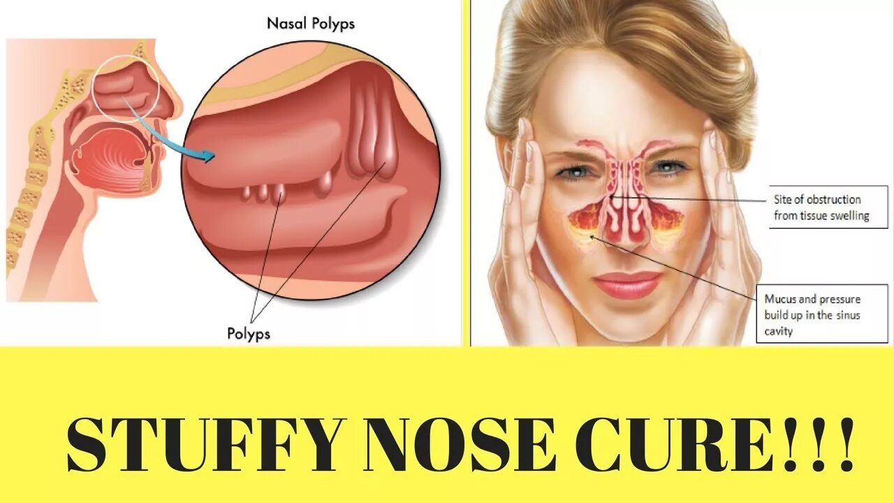 Полипы в носу симптомы у взрослых фото how to get rid of a blocked nose in 5 minutes - YouTube