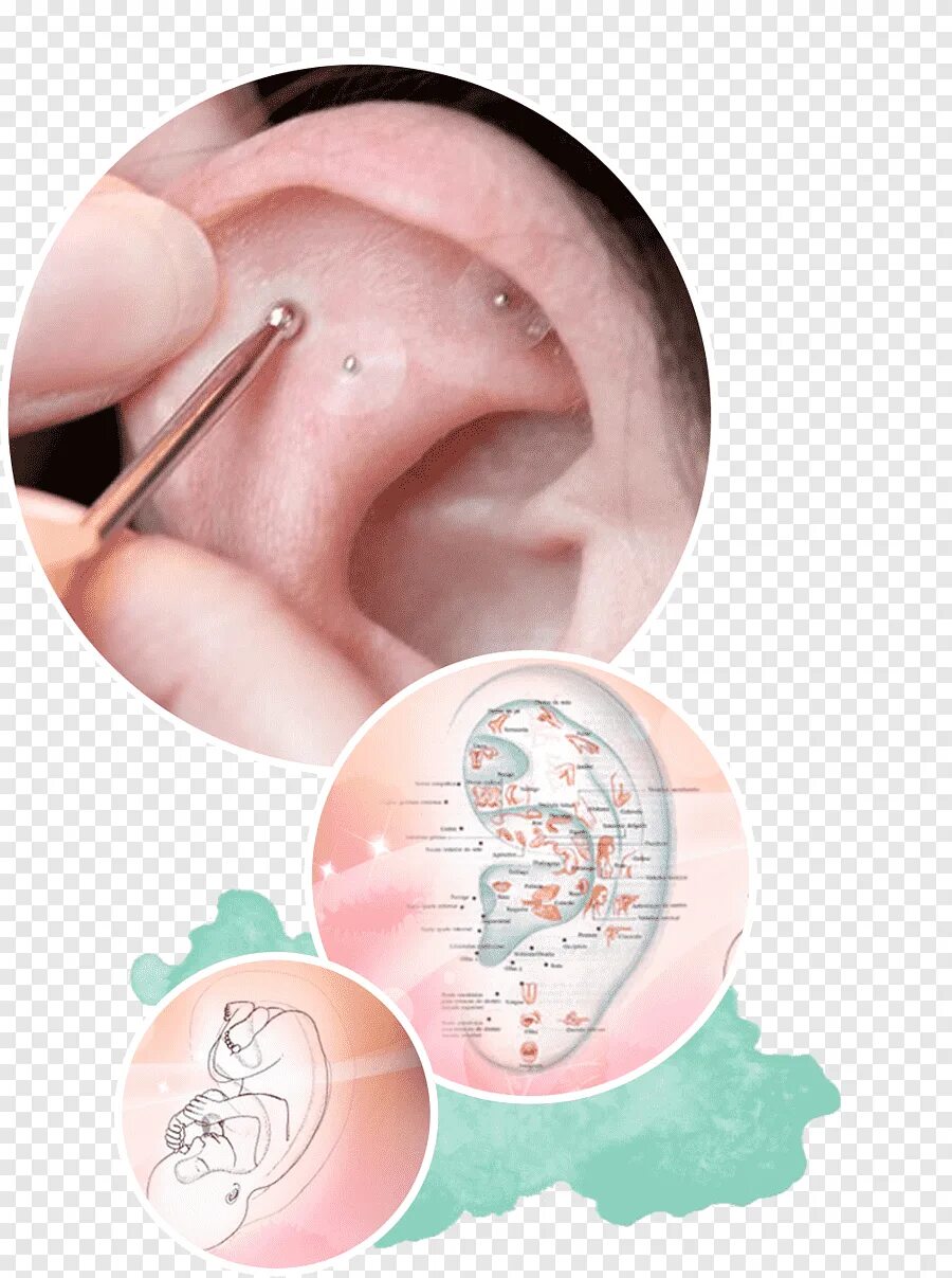 Полипы в ухе у человека фото Free download Auriculapy Acupuncture Auricle Ear, ear, people, traditional Chine