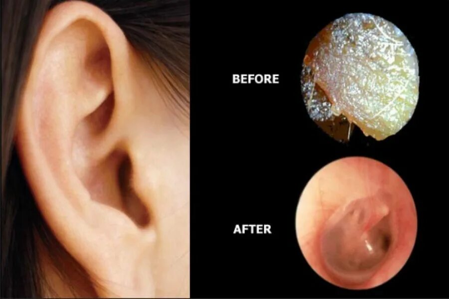 Полипы в ухе у человека фото The ears are one of the main organs that provide us with the ability to listen a