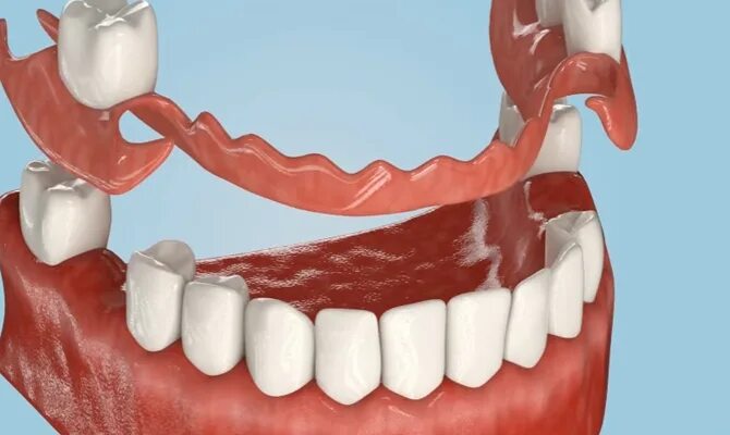 Полное отсутствие зубов фото Нейлоновые зубные протезы на Алексеевской недорого, цены на нейлоновые протезы з