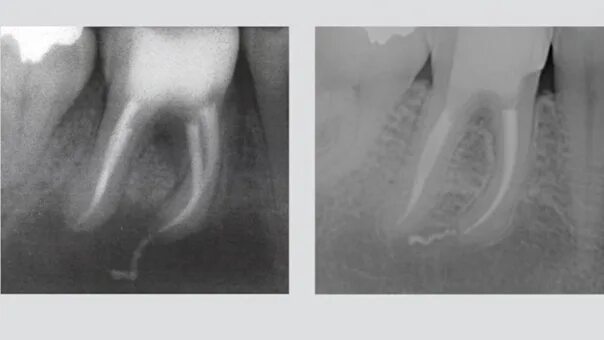 Полость зуба фото The discovery of a plombirical weapon was a result of an endodontic failure agai