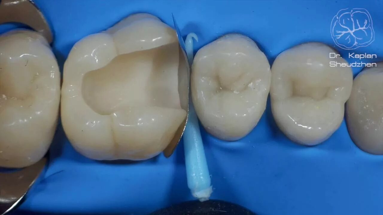 Полость зуба фото DentalПлюшки 11- адаптация матрицы - YouTube