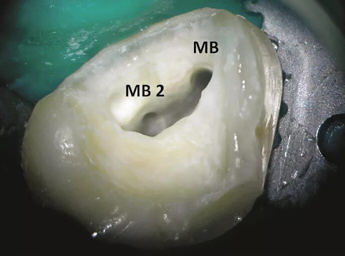 Полость зуба фото Немного о простом и главном... - DENTALMAGAZINE.RU