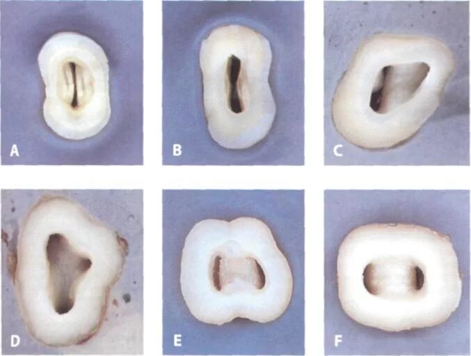 Полость зуба фото Несколько устьев