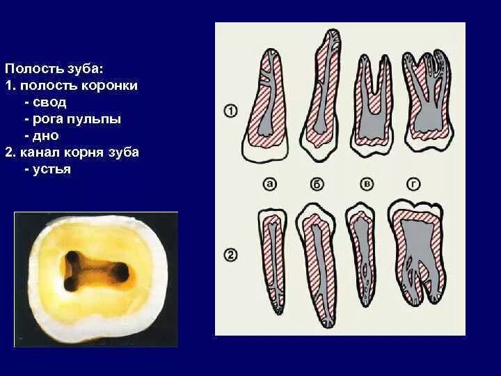 Полость зуба фото Свод полости