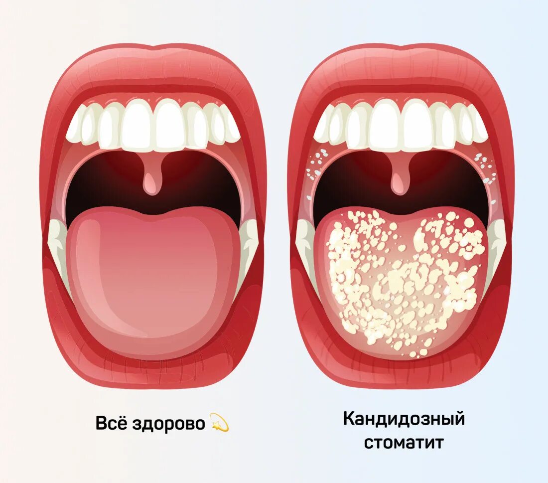 Полости рта симптомы фото Кандидозный стоматит - лечение грибкового стоматита, симптомы, причины