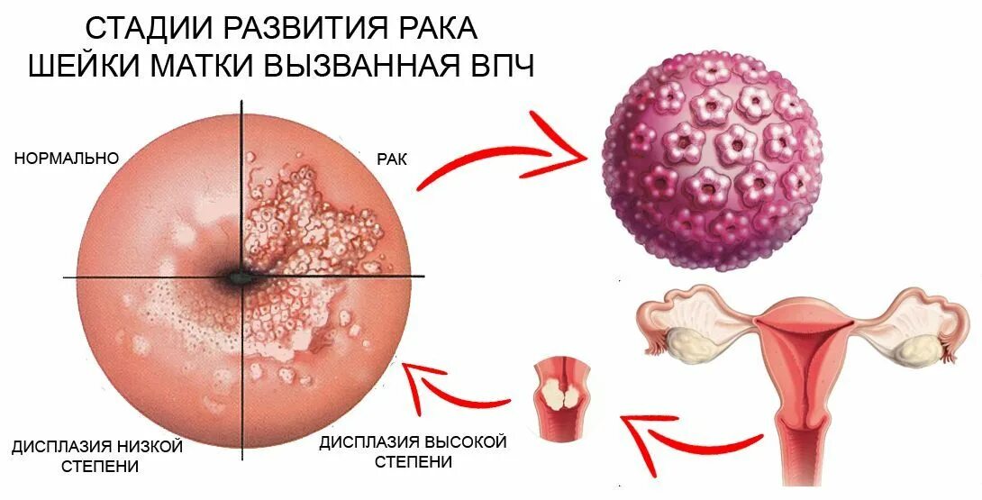 Половой генитальный герпес фото Папилломавирусная инфекция половых органов. ВПЧ у женщин. Типы ВПЧ, диагностика 