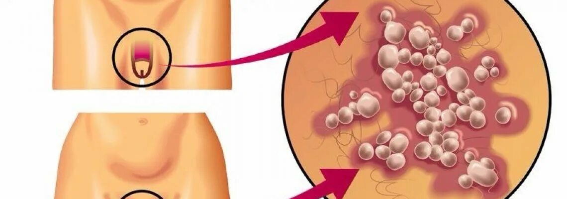 Половой генитальный герпес фото Рак головки полового