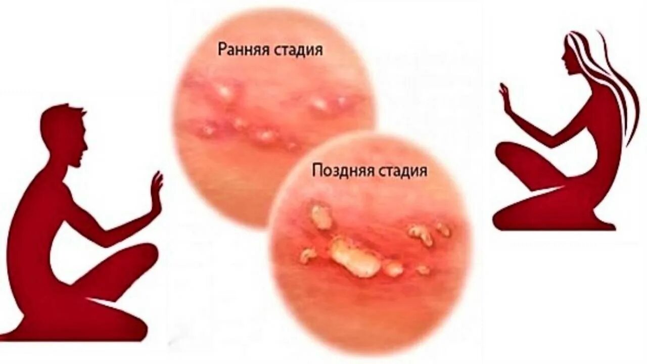 Половой генитальный герпес фото Новости