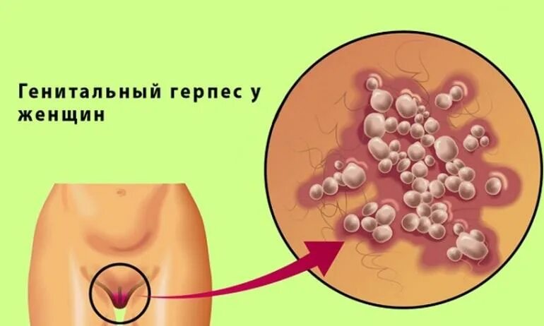 Половой герпес на головке фото Генитальный герпес у женщин: лечение болезни