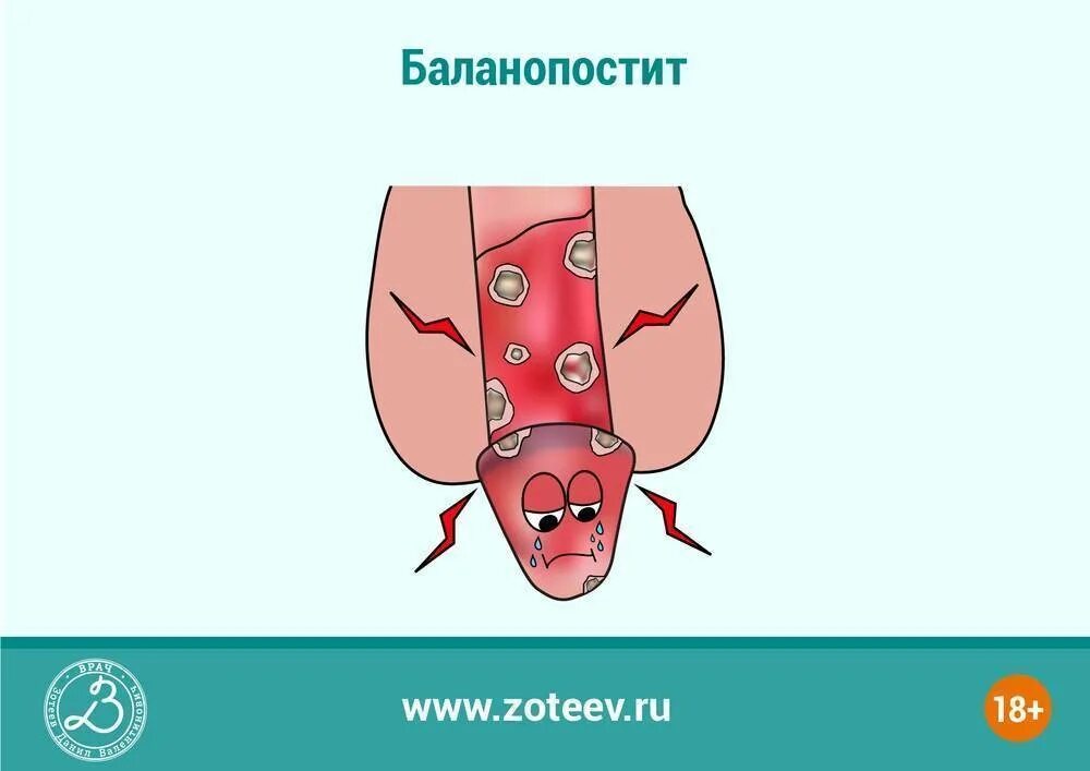 Половой герпес на головке фото Что делать при обнаружении припухлости и покраснения головки члена у грудничка