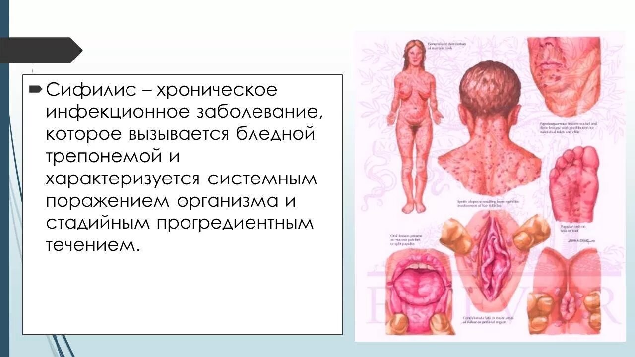 Половой герпес реальные фото Презентация - Сифилис " Привет Студент!