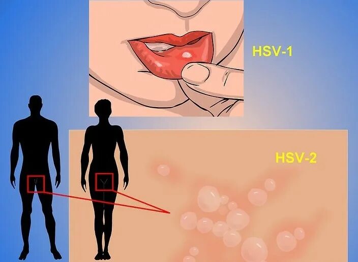 Половой герпес у мужчин признаки фото Половой герпес