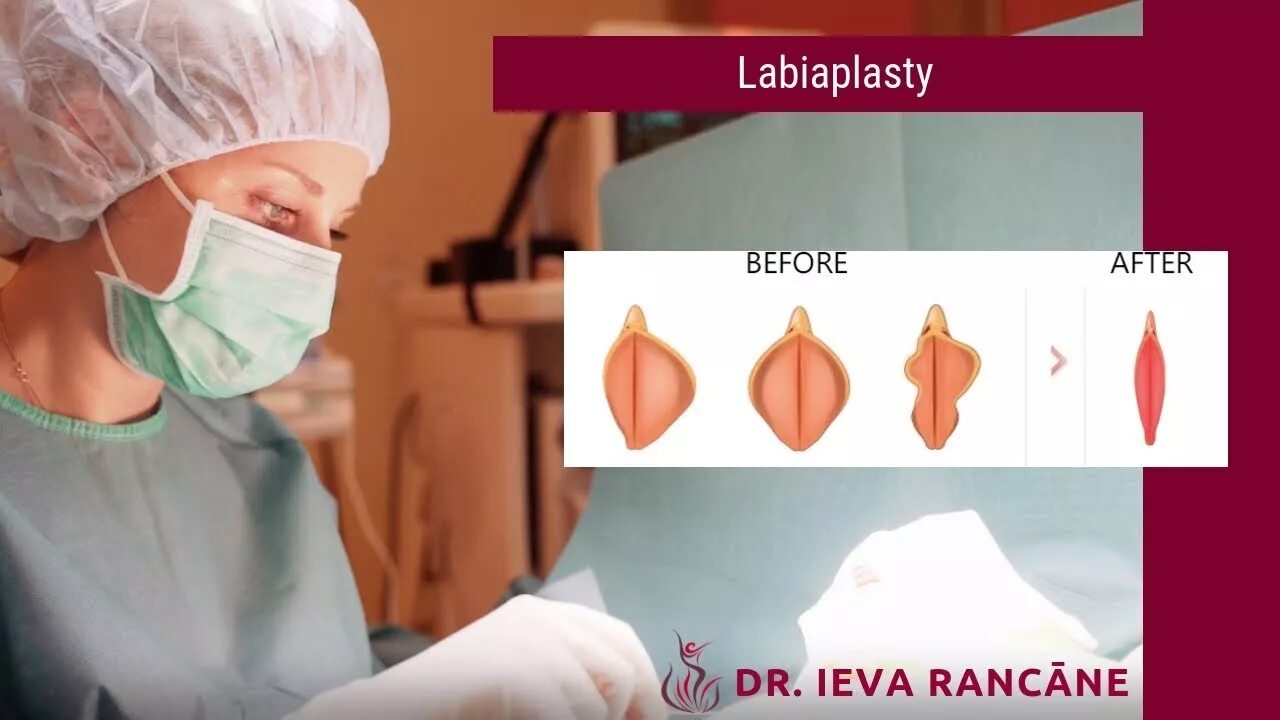 Половые губы фото до и после Intimate plastic surgery: labiaplasty - YouTube