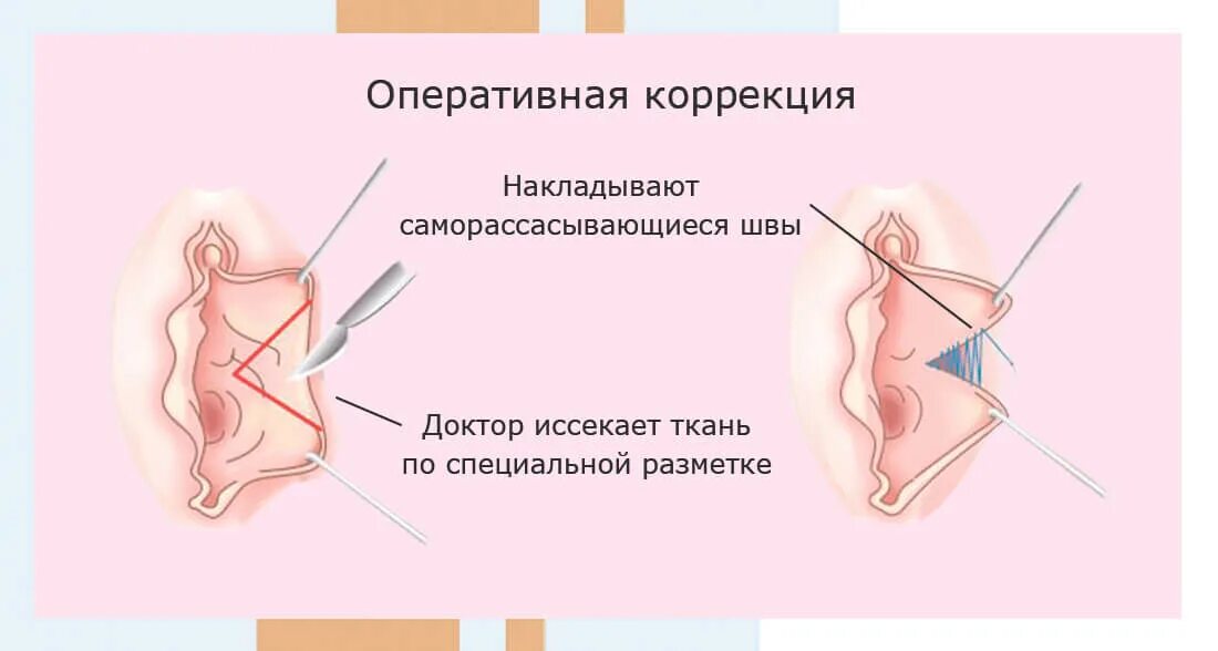 Половые губы фото до и после Лабиопластика в Москве - цена операции по пластике больших и малых половых губ