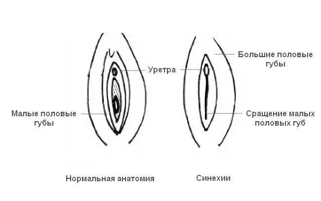 Половые губы снаружи фото Как ухаживать за половыми органами новорожденной девочки: особенности интимной г