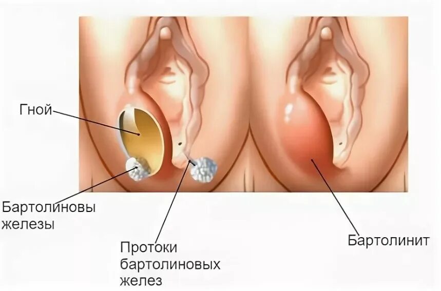 Половые губы снаружи фото Удаление кисты Бартолиновой железы