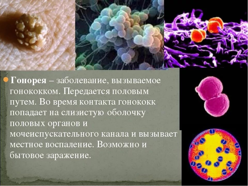 Половые инфекции у мужчин симптомы фото Инфекция половых путей у мужчин: найдено 84 картинок