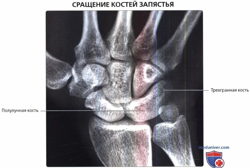 Полулунная кость фото Варианты нормы запястья на рентгенограмме, МРТ