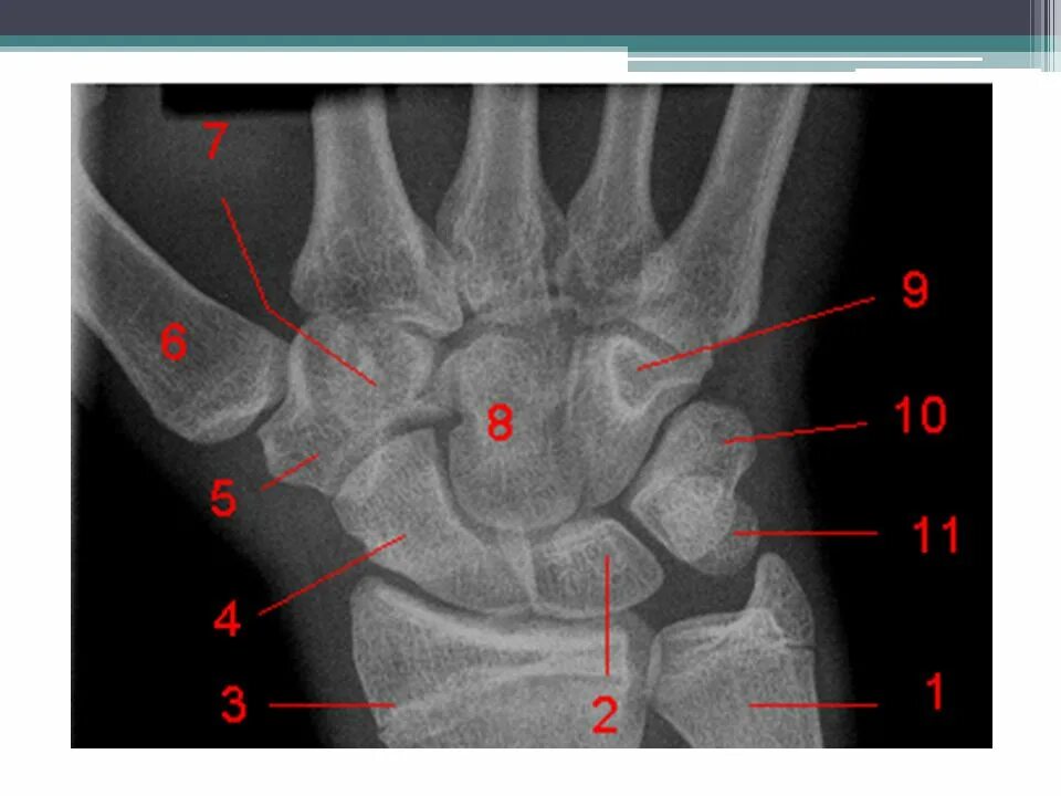 Полулунная кость фото OSTEOLOGIA DO MS Escápula Clavícula Úmero Rádio Ulna - ppt carregar