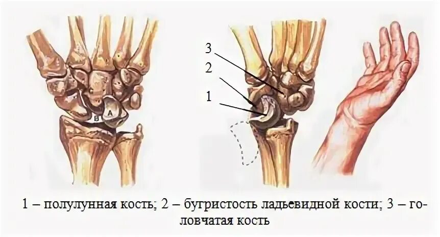 Полулунная кость фото 2.7.3. Травматические вывихи Электронная библиотека