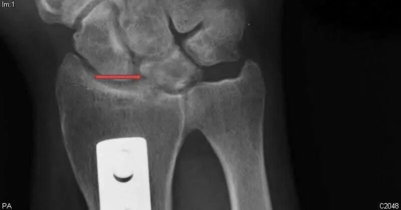 Полулунная кость фото Перелом Полулунной Кости Кисти Руки Фото - Telegraph