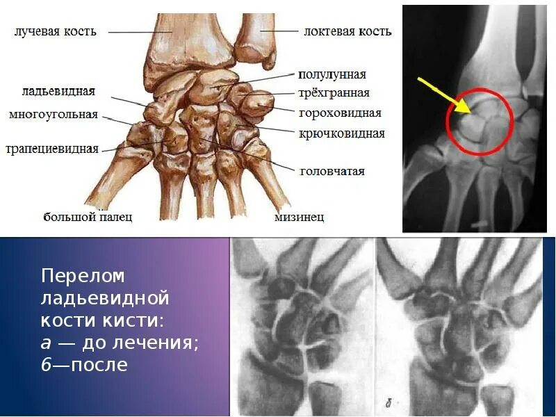 Полулунная кость кисти фото Скачать картинку ЛАДЬЕВИДНАЯ КОСТЬ КИСТИ ПЕРЕЛОМ № 29