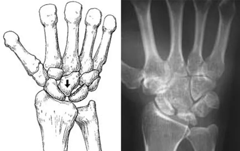 Полулунная кость кисти фото Болезнь Кинбека: симптомы, диагностика, варианты лечения, послеоперационный пери