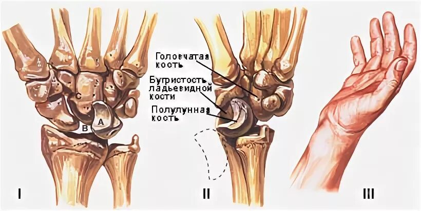 Полулунная кость кисти фото Вывихи костей запястья Спортивная медицина