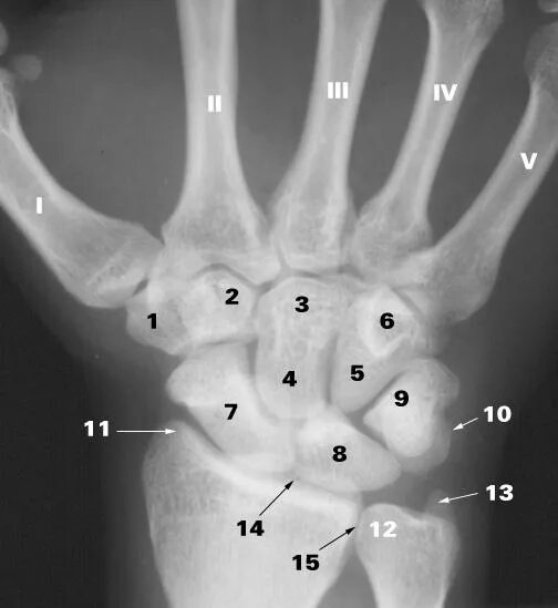 Полулунная кость кисти фото Index of /Images/static_web_tinyimagesdataset/r/radiocarpal_joint